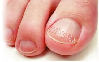 巻き爪矯正キット